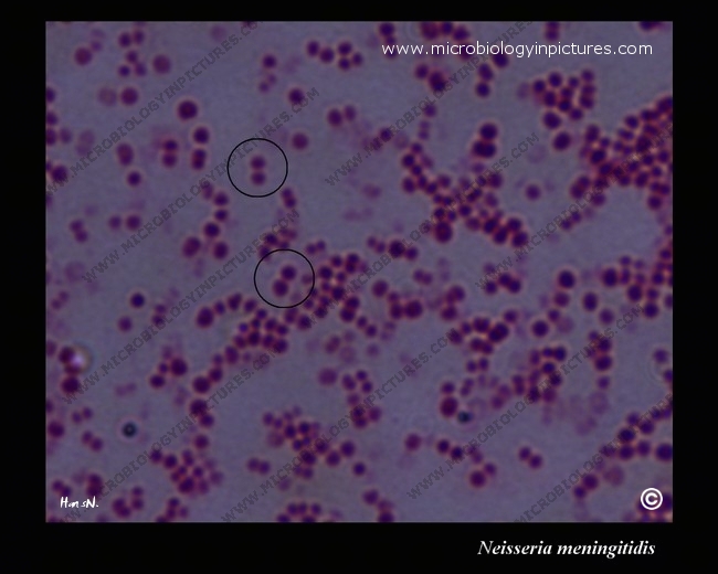 n meningitidis