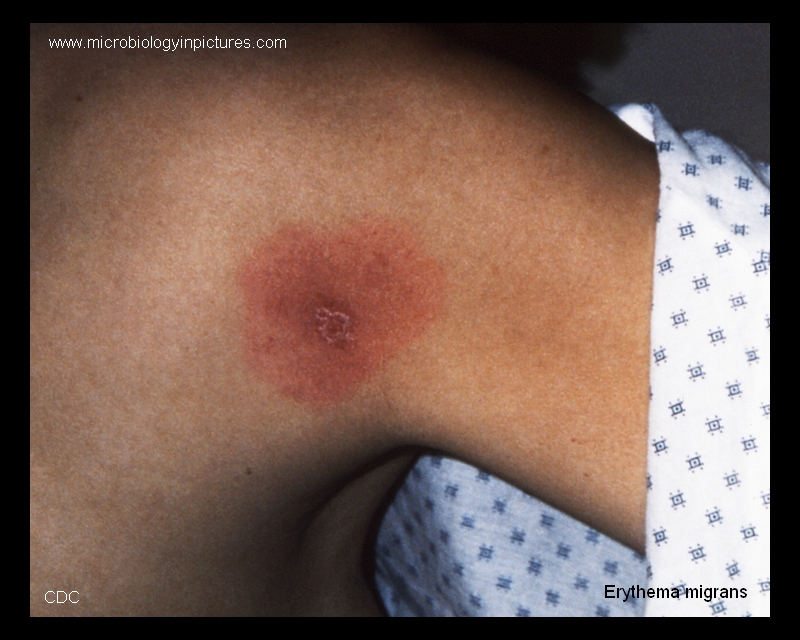 Lyme Disease Treatment, Pictures, and Symptoms