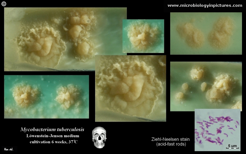 mycobacterium tuberculosis