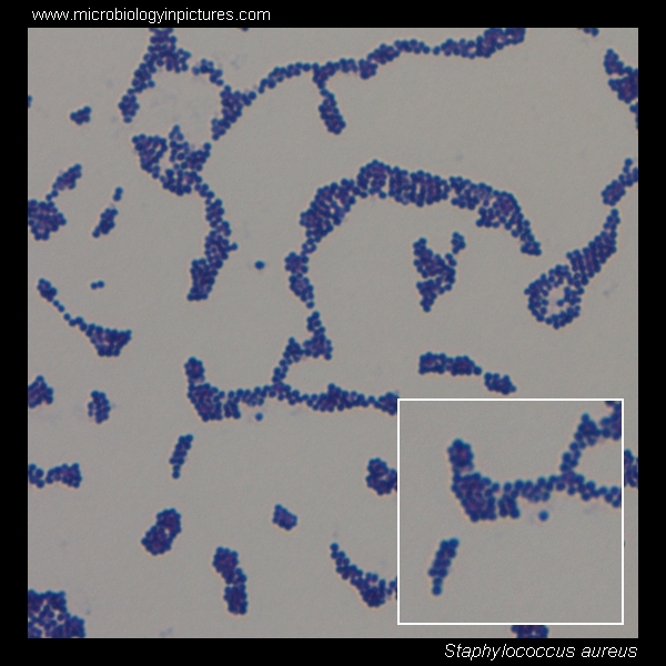 Staphylococcus aureus light microscopy. Morphology of Staphylococcus aureus  under the microscope. Micrograph of S.aureus, Gram stain. Gram-stained  smear from culture.