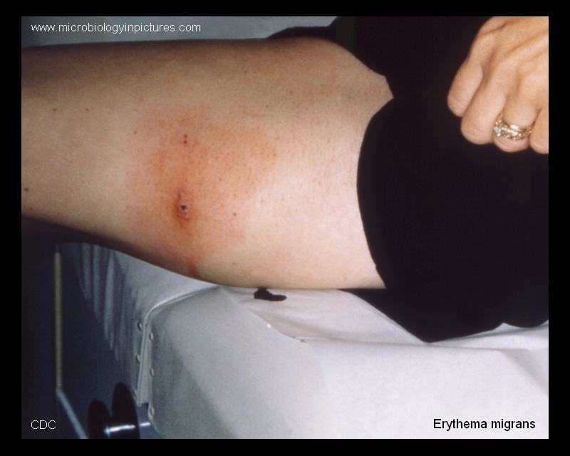 rash caused by borrelia