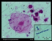 streptococcus pneumoniae in sputum, Gram stain