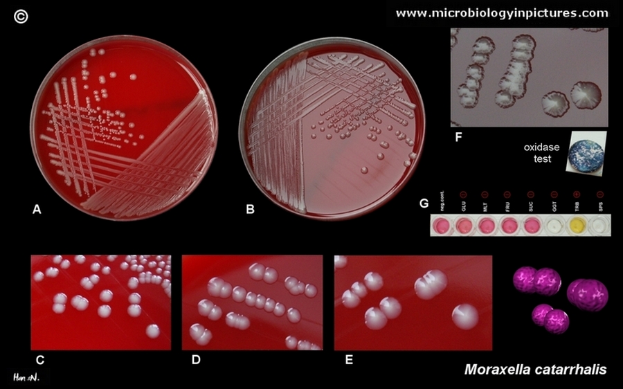What Is The Treatment For Moraxella Catarrhalis? – WBFL